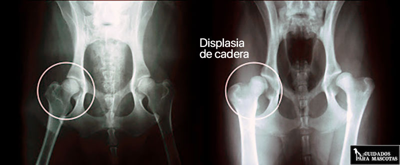 Displasia de cadera